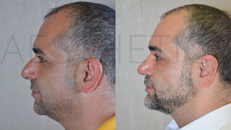 chin-implant-before-and-after-gallery-in-turkey-aesthetics-map-clinic