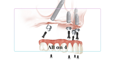 All-on-4 Dental Implants Turkey