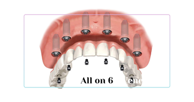 All-on-6 Dental Implants Turkey