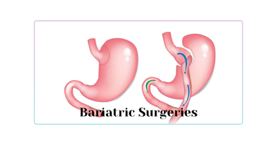 Bariatric Surgery in Turkey