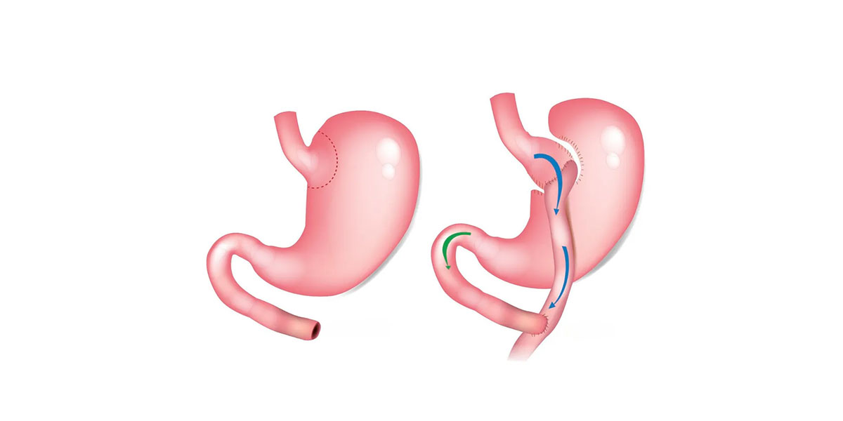 Bariatric Surgery in Turkey