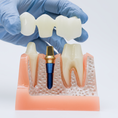 Dental Bridges Turkey