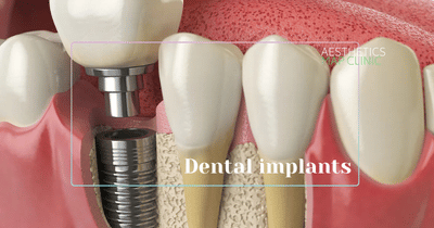Dental implant placement illustration showing titanium implant and crown - AMC Dental Turkey, Istanbul