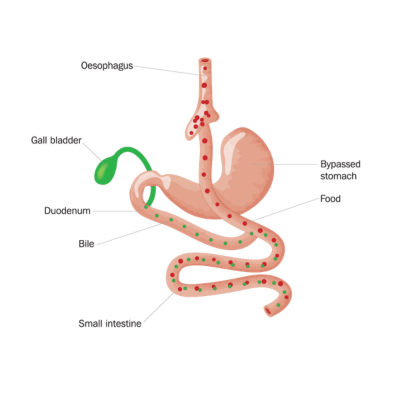 Gastric Bypass Turkey