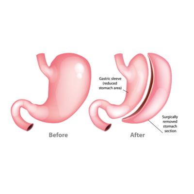 Gastric Sleeve Turkey