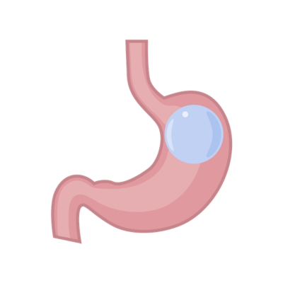 Gastric Balloon Turkey