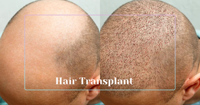 Hair Transplant in Turkey