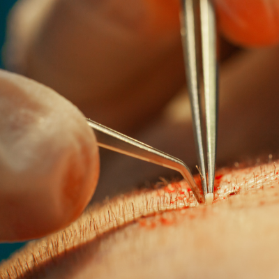 FUE Hair Transplant Turkey