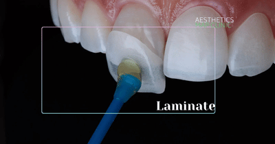 E-max Crowns and Veneers Turkey