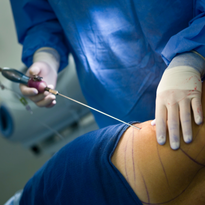 Liposuction Turkey