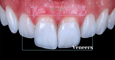 Porcelain Veneers Turkey