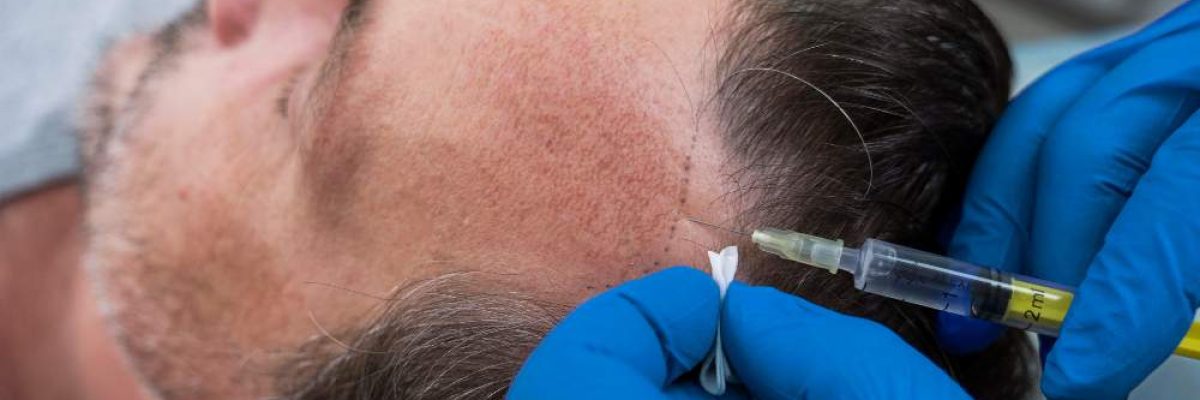 Hair-transplant-in-istanbul-